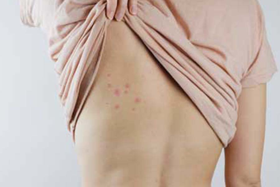 Man pulling up shirt to reveal bed bug bites on back - Keep bed bugs out of your home with Bug Out in St. Louis